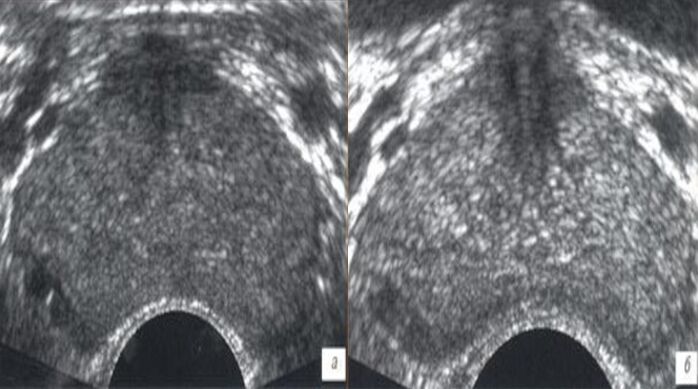 Ultraschall vor und nach der Behandlung mit Prostovit-Tropfen