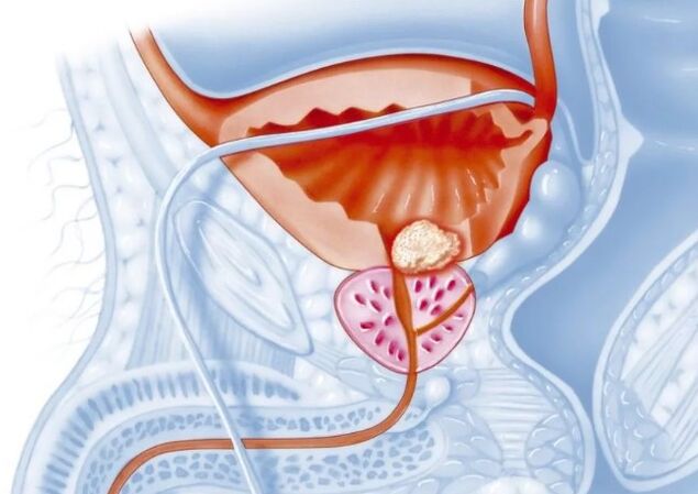 Eigenschaften der chronischen Form der Prostatitis