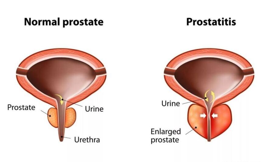 Normale und entzündete Prostata