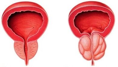 Gesunde Prostata und mit Prostatitis entzündet